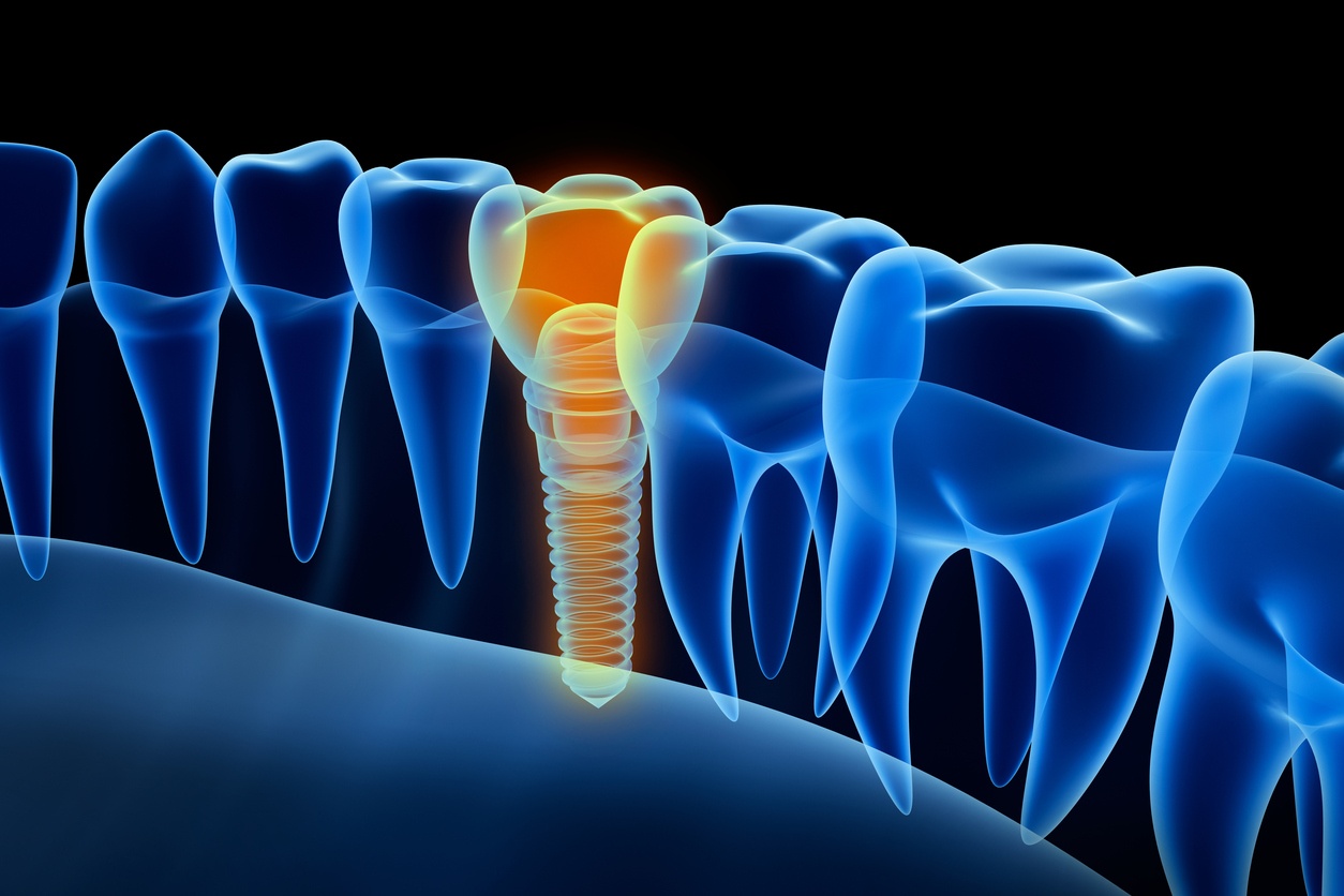 dental implants wire drawing.jpg